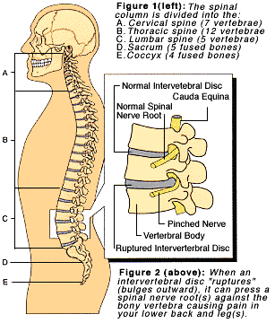 Sciatica