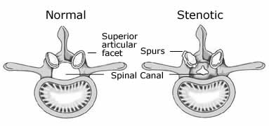 Spinal Stenosis