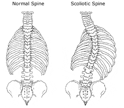 Spinal Stenosis